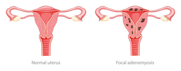 Adenomyosis Focal Human anatomy Female Sick and normal reproductive system organs. Location scheme Cross section uterus, cervix, ovary, fallopian tube icon. Vector illustration isolated on white