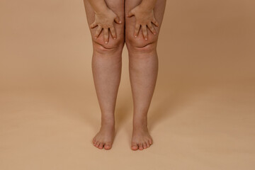 Cropped photo of woman bare naked legs, pinching fat on knees. Clipping fat folds. Removal of fat...