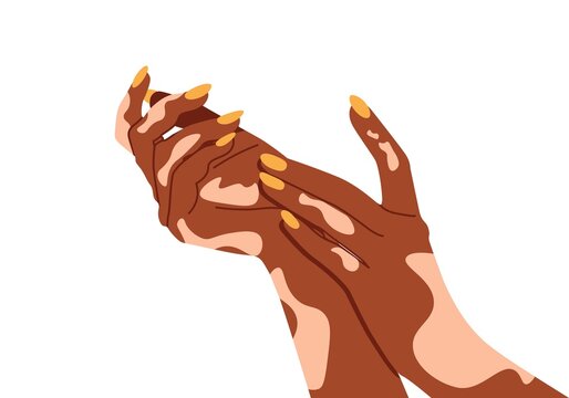 Hands with vitiligo disorder. Poster for supporting people living with vitiligo.