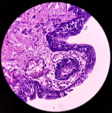 Prostate Cancer(TURP): Microscopic image of prostatic tissue, adenocarcinoma, malignant neoplasm,atypical epithelial cells, malignant tumor