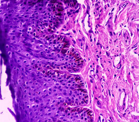 Prostate histology(TURP): Photomicrograph of biopsy of prostate gland showing fibromuscular tissue. no malignant cells present.