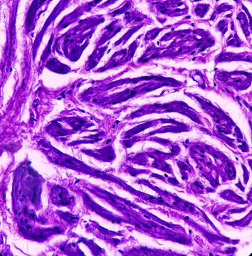 Prostate histology(TURP): Photomicrograph of biopsy of prostate gland showing fibromuscular tissue. no malignant cells present.