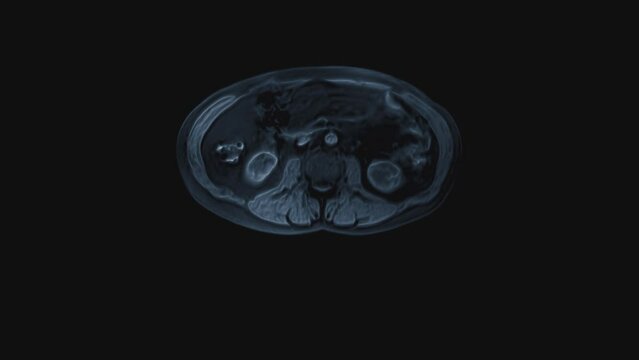 Voluminous color CT scan of the abdomen. Computed tomography of the gastrointestinal tract, liver and kidneys