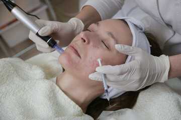 Mesotherapy. Woman having dermapen facial treatment.
Micro needle cosmetic treatment at dermatologist.