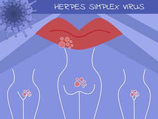 Herpes simplex virus (HSV) - obrazy, fototapety, plakaty
