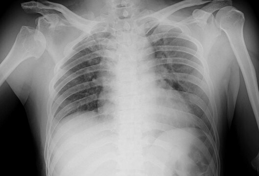 right shoulder dislocation,Xray
