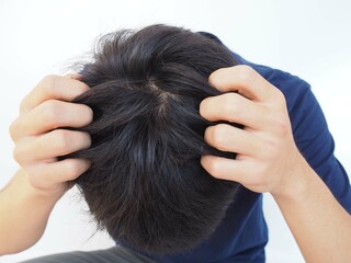 Fototapeta premium Dandruff or lice in his hair man and scratching her head for healthcare concept. closeup photo.