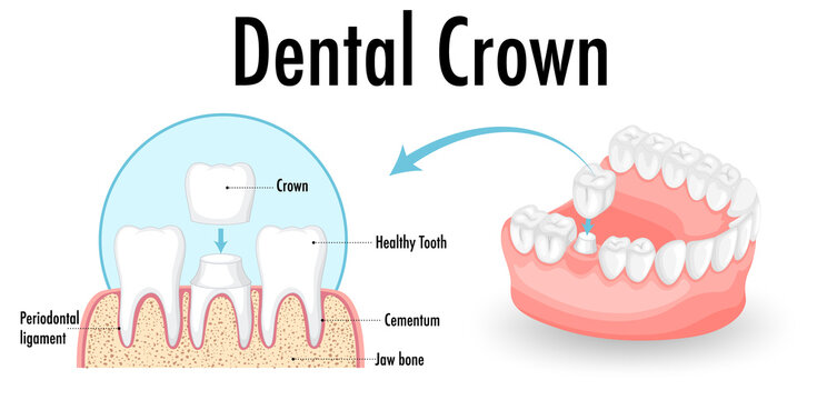 Infographic of human in dental crown