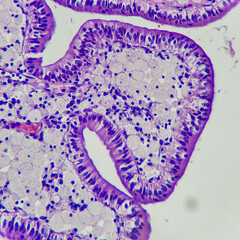 Camera photo of cholesterolosis in gallbladder, showing aggregation of foamy histiocytes in the...