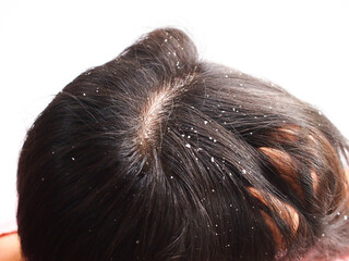 Closeup Woman with dandruff in her hair. Problem health care concept. - obrazy, fototapety, plakaty
