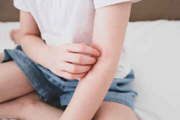 Fototapeta na wymiar The child scratches atopic skin. Dermatitis, diathesis, allergy on the child's body.