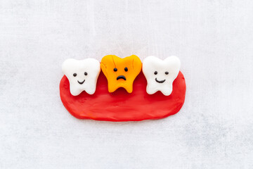 Oral health concept. Healthy and caries teeth models on gums