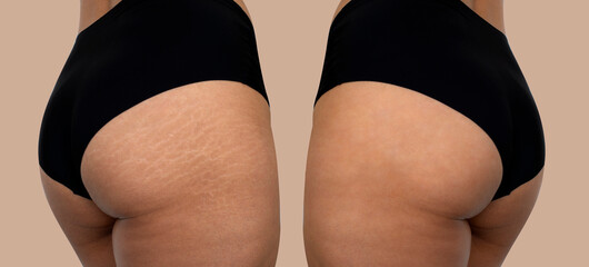 Image compare before and after Woman buttocks, hip with stretch marks removal treatment, real people.