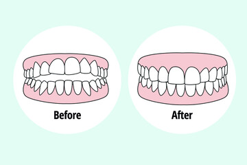 Malocclusion Crowding. Dental problem vector illustration. Dental care concept.