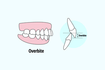 Lateral Overbite. Dental problem vector illustration. Dental care concept.