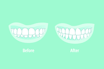 Malocclusion After and before. Dental problem vector illustration. Dental care concept.