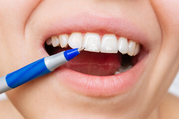 Cropped shot of a young caucasian woman pointing to white spots on the tooth enamel with a pen. Oral hygiene, dental health care. Dentistry, demineralization of teeth, enamel hypoplasia, fluorosis