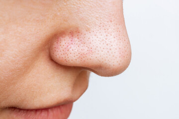 Close-up of a woman's nose with black heads or black dots isolated on a white background. Acne problem, comedones. Enlarged pores on the face. Cosmetology dermatology concept. Blackheads on oily skin - obrazy, fototapety, plakaty