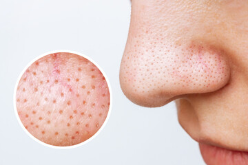 Female nose with blackheads or black dots and magnifying glass with an enlarged image of the pores...