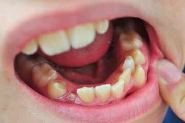 Child teeth with malocclusion