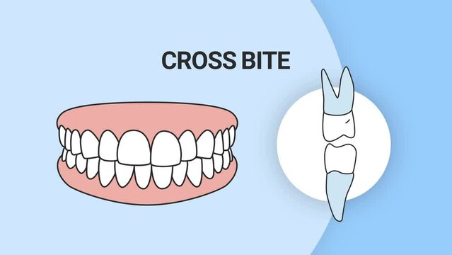 Malocclusion Cross Bite. Dental problem. 3d illustration. Dental care concept.