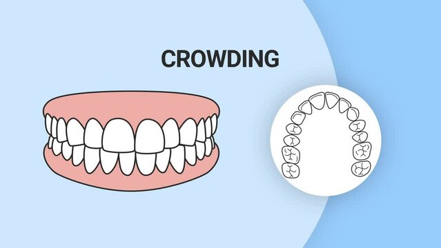 Malocclusion Crowding. Dental problem. 3d illustration. Dental care concept.