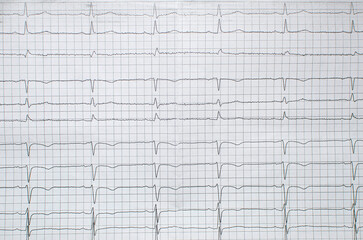 Cardiogram showing myocardial infarction