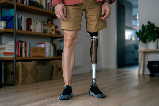 Crop Person With Leg Prosthesis