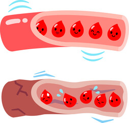 柔らかい血管と硬い血管の血流のイメージ