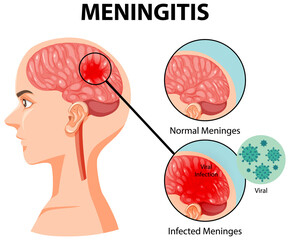 Diagram showing meningitis in human brain - obrazy, fototapety, plakaty