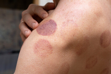Acupressure of .shoulders of man. Man with blood marks massaged after taking cupping therapy.
