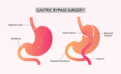 Gastric bypass surgery before and after medical illustration. - obrazy, fototapety, plakaty