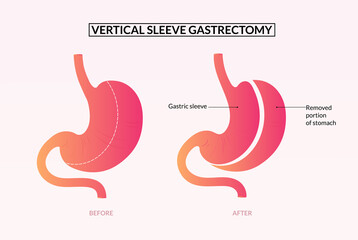 Vertical sleeve gastrectomy surgery  medical illustration.
