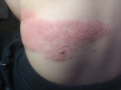 Shingles viral infection caused by the varicella-zoster virus on kid body