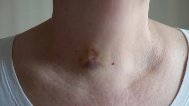 bruises on the neck of a woman as a consequence of laser removal of a benign tumor of the thyroid gland