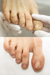 Collage. toes before and after the pedicure procedure with the installation of a metal titanium...