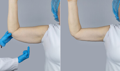 Before and after. Brachioplasty. Plastic arms, dangling skin at the elbow. An older woman shows the...