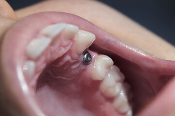Obraz premium Close up of a real mouth with dental molar screw implant.