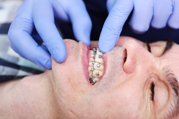 A man with braces at an orthodontist's appointment. Adjustment of braces during wearing. Open mouth. Modern dentistry. A photo in a real clinic. Close-up.