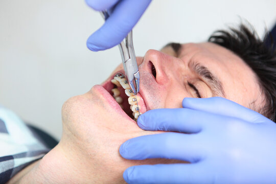 The work of an orthodontist. Adjustment of braces during wearing. Braces on the teeth. A man at an orthodontist's appointment. Open mouth. Modern dentistry. A photo in a real clinic. Close-up.