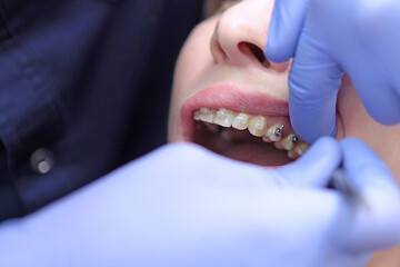 Ceramic braces and metal braces on the patient's teeth. Two types of braces on the teeth.Correction of bite and tooth growth. The work of an orthodontist. Modern dentistry.