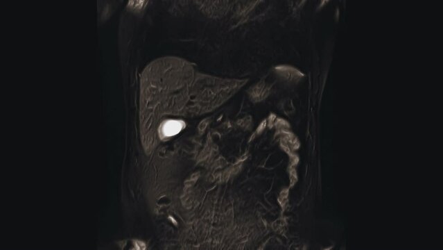 Voluminous color CT scan of the abdomen. Computed tomography of the gastrointestinal tract, liver and kidneys