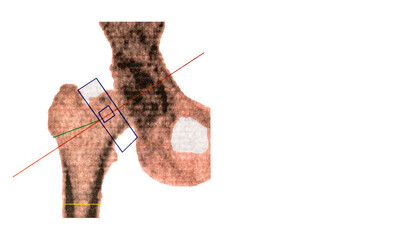 Medical scan of right femoral bone density. Diagnosis of osteoporosis in women over 50 at...