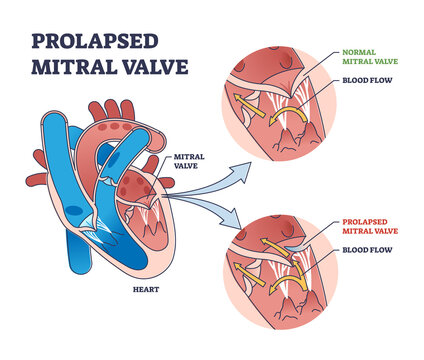 Prolapsed mitral valve heart disease comparison with normal outline diagram. Labeled educational cardio dysfunction with medical chamber closure differences because of illness vector illustration.