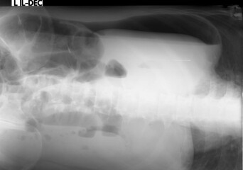 Pneumoperitoneum. LLD abdominal x-ray 
