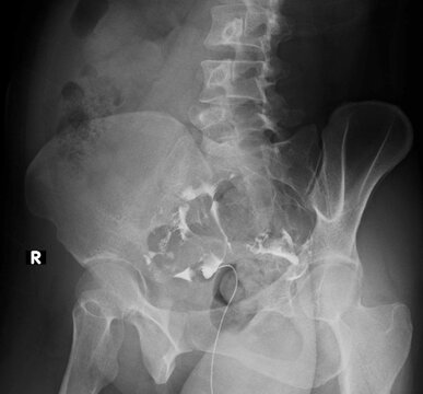 x-ray image of  Normal Hysterosalpingography (HSG) 
