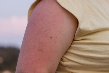 irritated sunburn on womans arm in summer