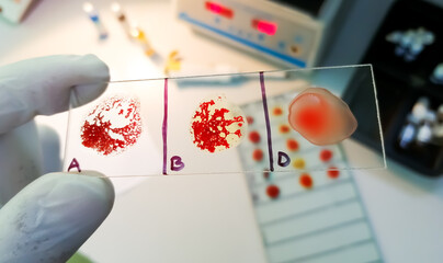 AB negative rare Blood group testing by slide agglutination