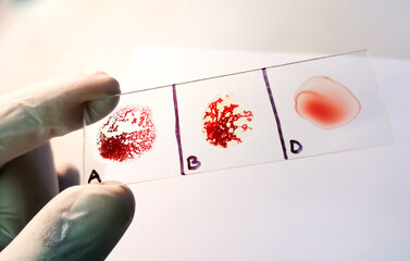 AB negative rare Blood group testing by slide agglutination