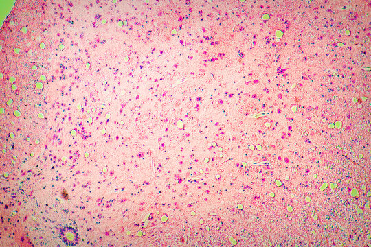 Tissue Slice Biopsy To Check For A Malignant Tumor. View In A Microscope